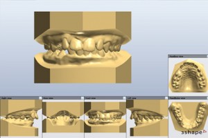 Numérisation, modèle d'étude 3D et impression 3D Orthoklass